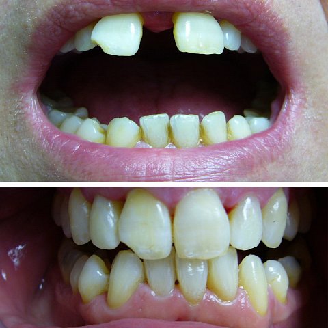 Zahnlücke (Diastema)
